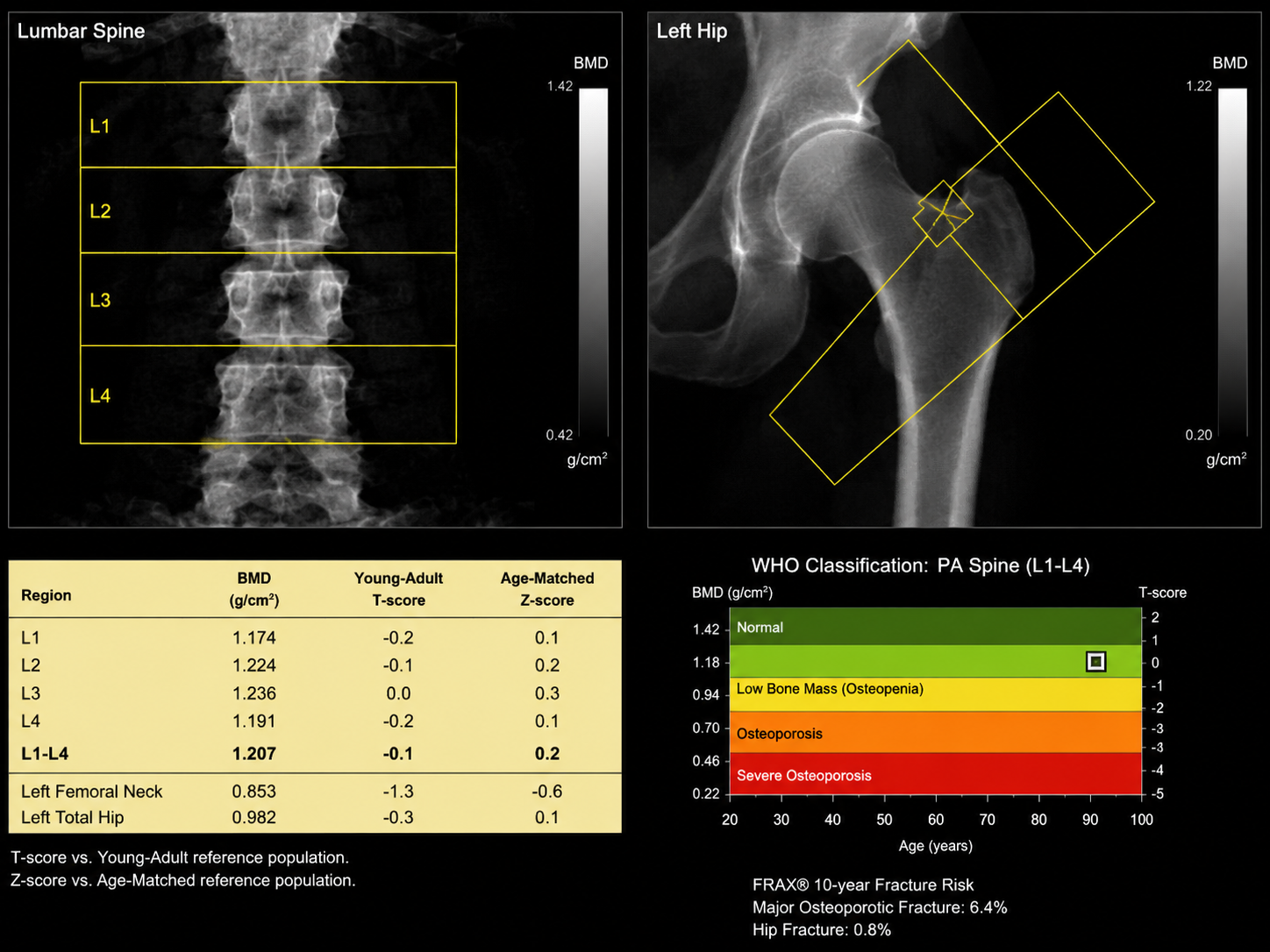 Bone Mineral Density (BMD) at Merivale Medical Imaging