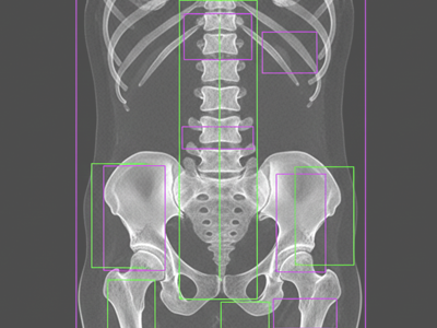 Bone Mineral Density (BMD) at Merivale Medical Imaging