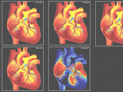 Myocardial Perfusion Imaging (MPI) at Merivale Medical Imaging