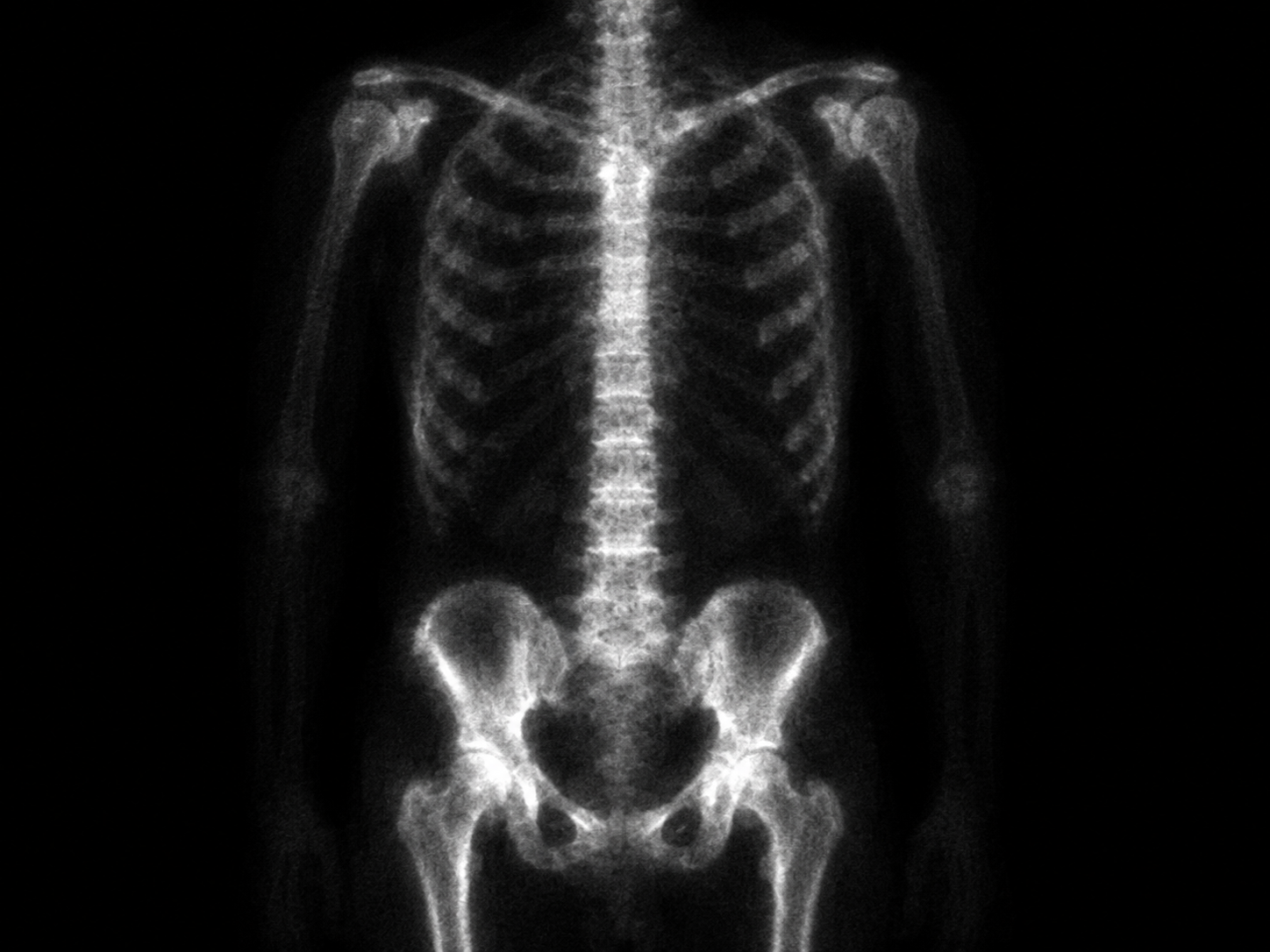 Nuclear Medicine - Bone Scan at Merivale Medical Imaging