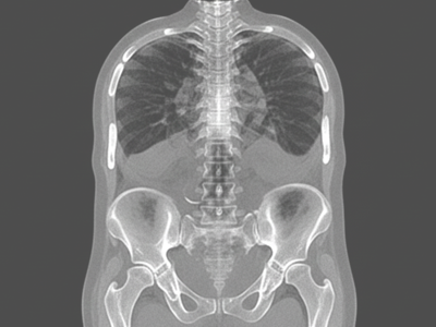 Nuclear Bone Scan at Merivale Medical Imaging
